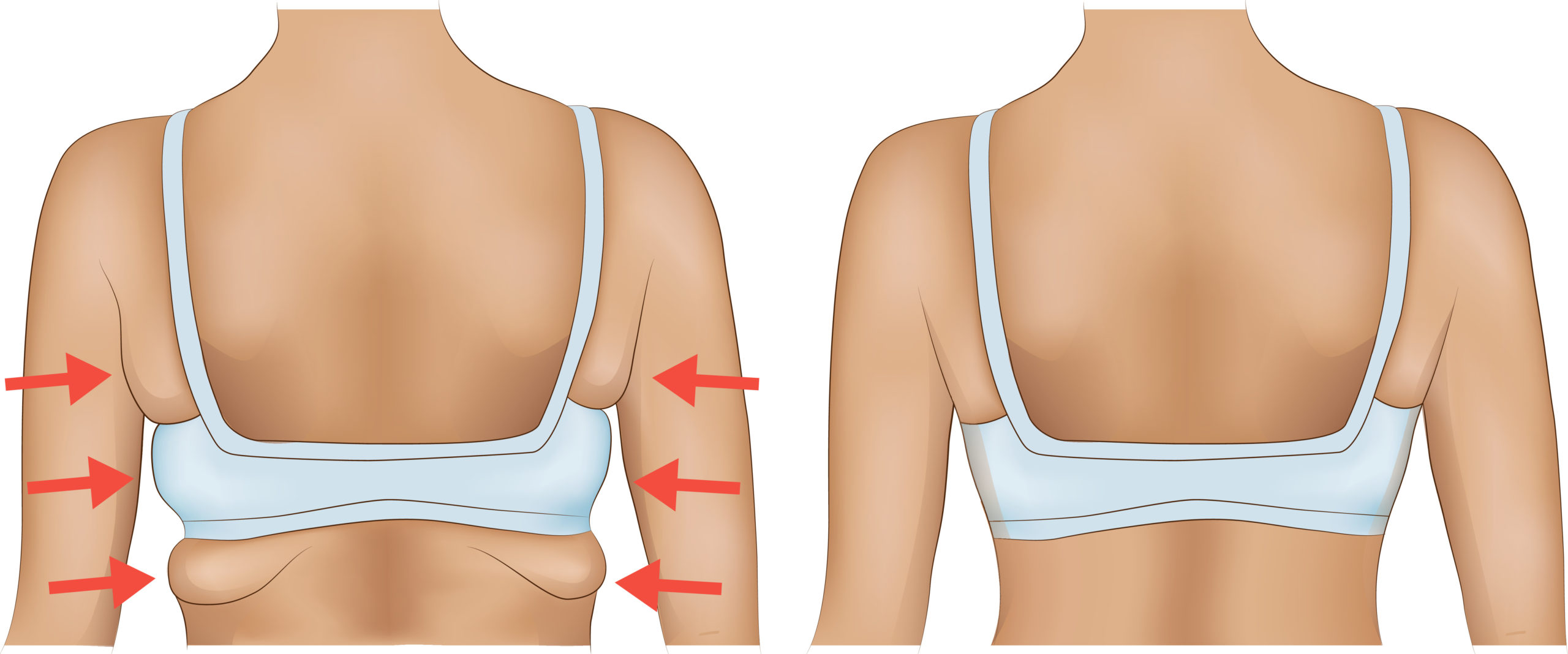INFS, Bra bulge refers to the excess fat or skin, pushed out from  underneath the back or underarms, while wearing a bra. Is it possible to