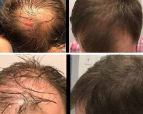 Bald Young Man Before & After Image in 690 Van Buren St, Eugene, OR| Refine Medical Center