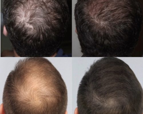Bald Young Man Before & After Image | Refine Medical Center & medical spa