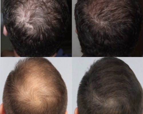 Bald Young Man Before & After Image in 690 Van Buren St, Eugene, OR| Refine Medical Center