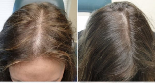 Natural Growth Factor Injections HAIR RESTORATION before & after images in 690 Van Buren St, Eugene, OR| Refine Medical Center