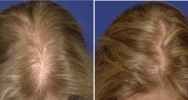 Natural Growth Factor Injections HAIR RESTORATION before & after images in 690 Van Buren St, Eugene, OR| Refine Medical Center