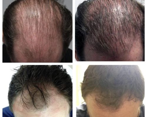 Bald Young Man Before & After Image in 690 Van Buren St, Eugene, OR| Refine Medical Center