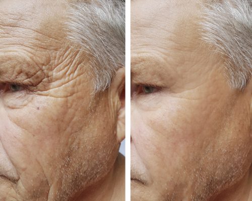 Wrinkles face before and after procedures images