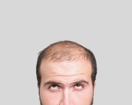 Bald young man, front view in 690 Van Buren St, Eugene, OR| Refine Medical Center