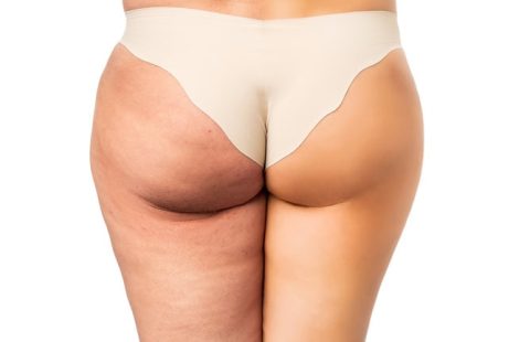 Cellulite Treatment | Refine Medical Center and Medical Spa | Eugene, OR