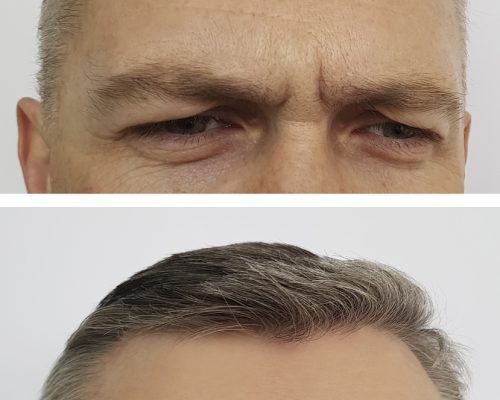 Man Wrinkles on the forehead before and after images | Refine Medical Center and Medical Spa | Eugene, OR