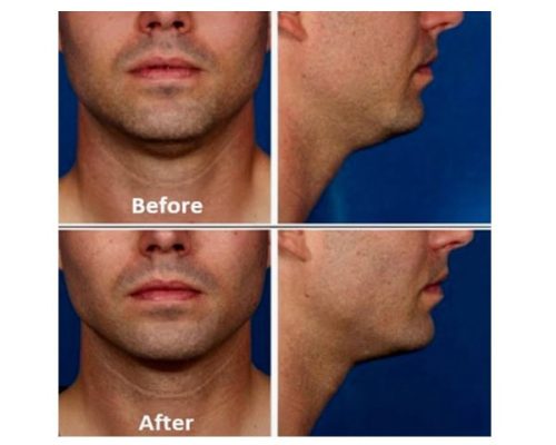 Male before & after images | Refine Medical Center and Medical Spa | Eugene, OR