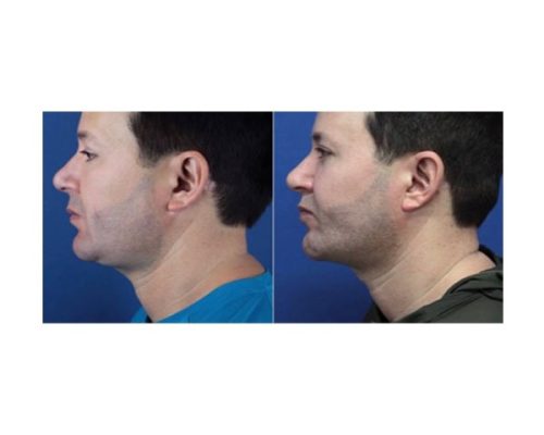 Male before & after images | Refine Medical Center and Medical Spa | Eugene, OR