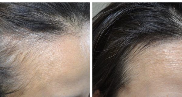 Natural Growth Factor Injections HAIR RESTORATION before & after images