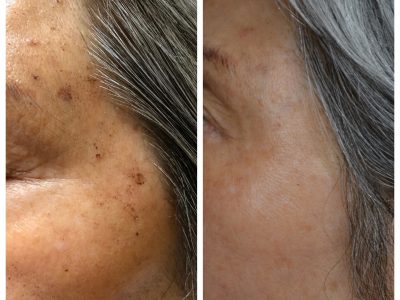 Skin Scars | Before & after images