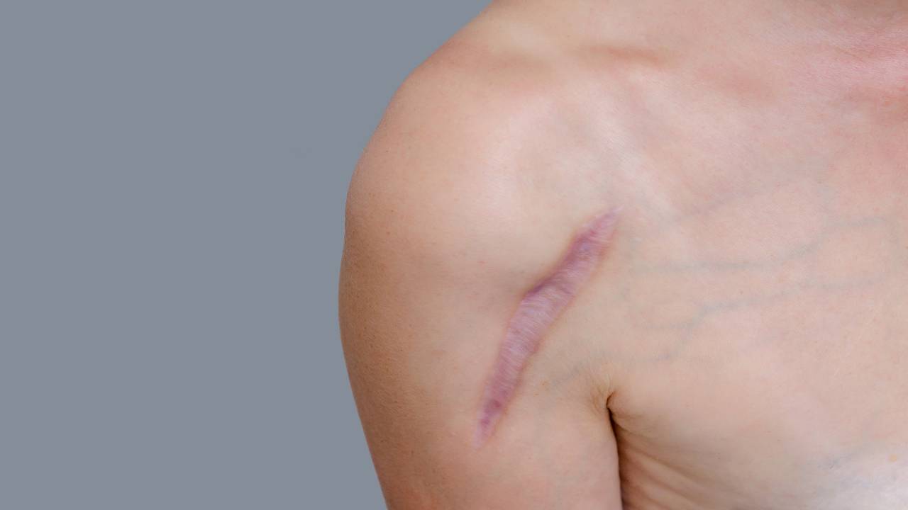 Scarring treatment