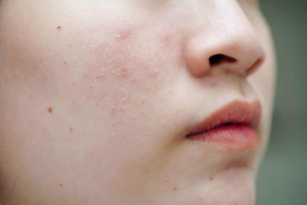 Scarring What Is It Its Types Treatments 1024x683 1