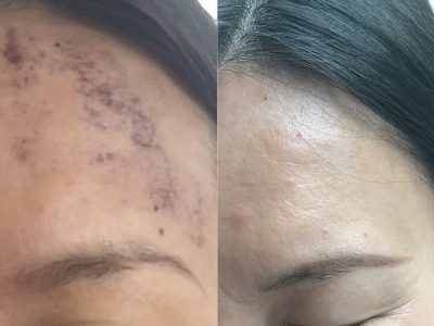 Skin Scars | Before & after images