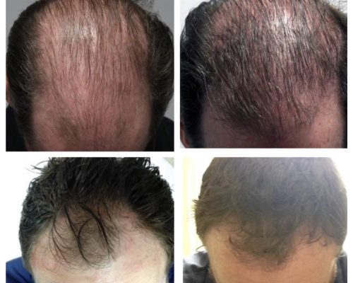 Male Aesthetics 12 Bald Young Man Before & After Image | Refine Medical Center & medical spa
