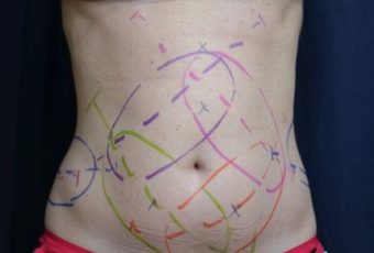 CoolSculpting CoolSculpting