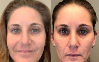 Hyaluronic Acid (HA) Filler 3 Hyaluronic Acid (HA) Filler