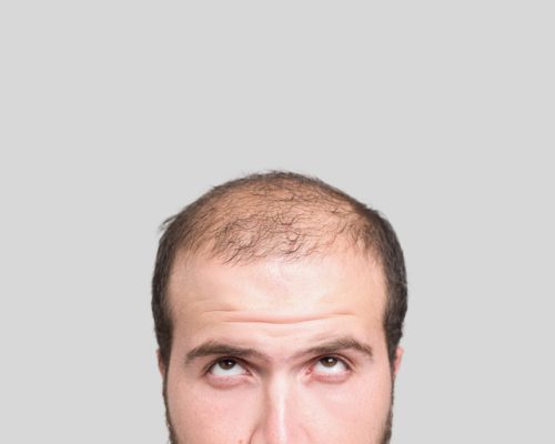Bald young man, front view Refine Medical Center & medical spa