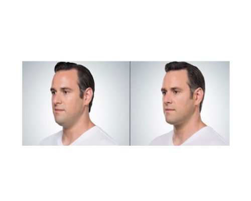 Male before & after images | Refine Medical Center and Medical Spa | Eugene, OR